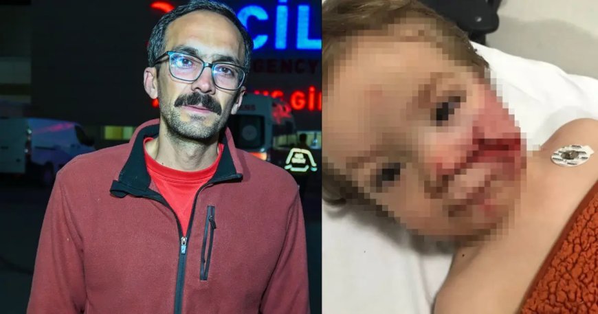 Başkentte pitbull dehşeti. İki kardeş yaralandı, birinin yüzü parçalandı