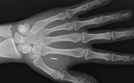 Vücuduna yerleştirdiği çipin şifresini unuttu