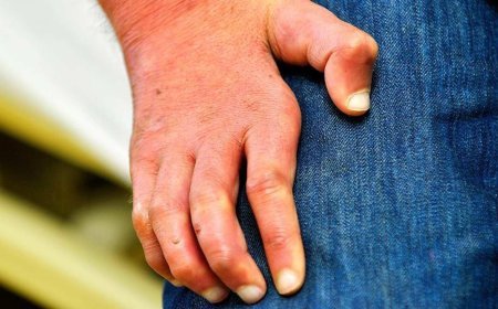 44 yıl sonra ortaya çıktı! Avrupa'da panik: Belirtileri his ve sinir kaybı...