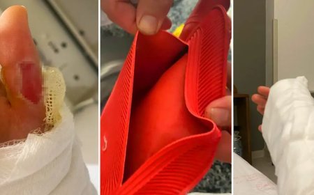 Sıcak su torbası patladı, vücudunun yüzde 25'i yandı