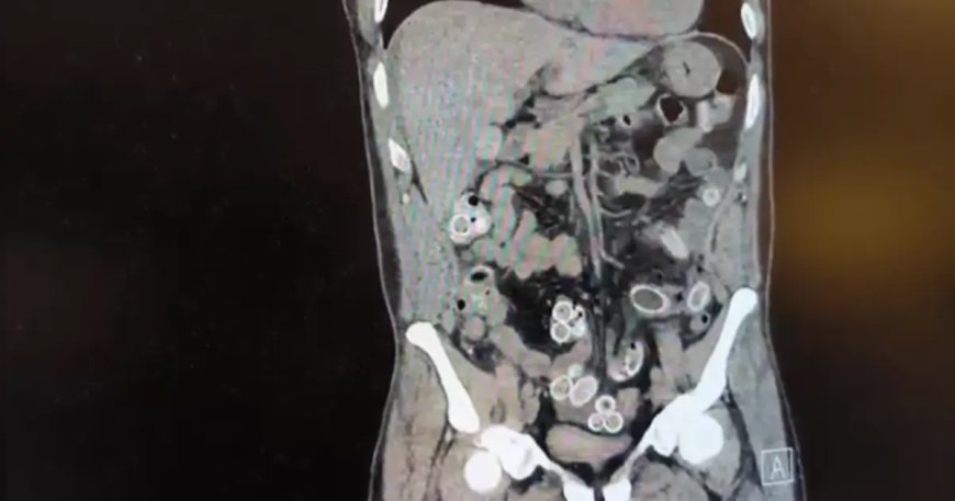 Ağrıyla hastaneye gitti, hepsini midesine gizlemiş. Tutuklandı