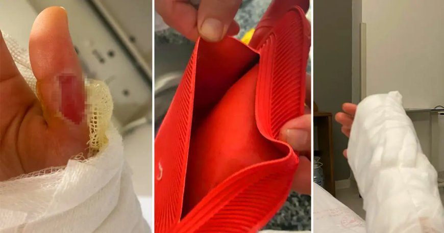 Sıcak su torbası patladı, vücudunun yüzde 25'i yandı