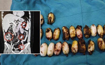 44 kapsül bonzaiyi midesinde saklamış! Cerrahi müdahale ile çıkarıldı