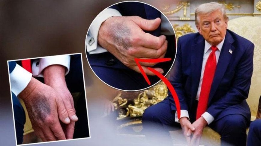 Trump elindeki morlukların sebebini açıkladı! Çeşitli söylentiler vardı