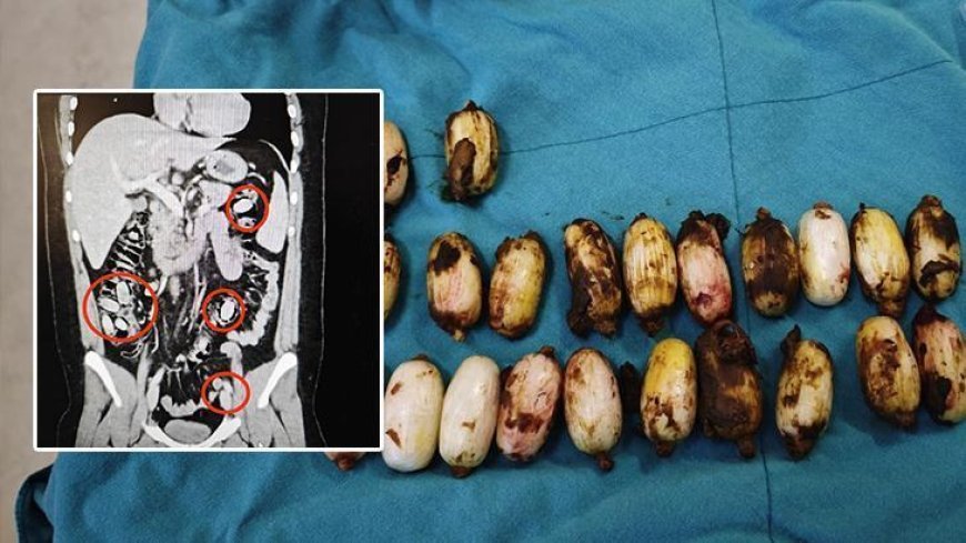 44 kapsül bonzaiyi midesinde saklamış! Cerrahi müdahale ile çıkarıldı