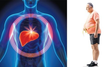 Küresel salgın: Karaciğer yağlanması